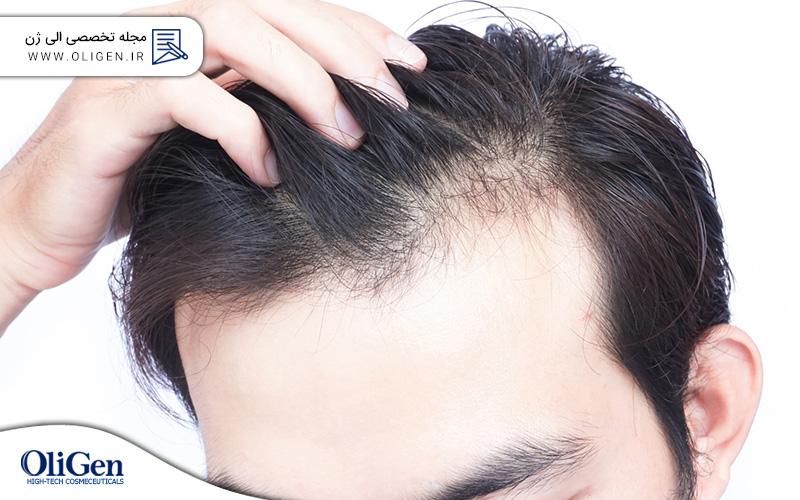 چگونه می توان از ریزش مو در سنین پایین جلوگیری کرد