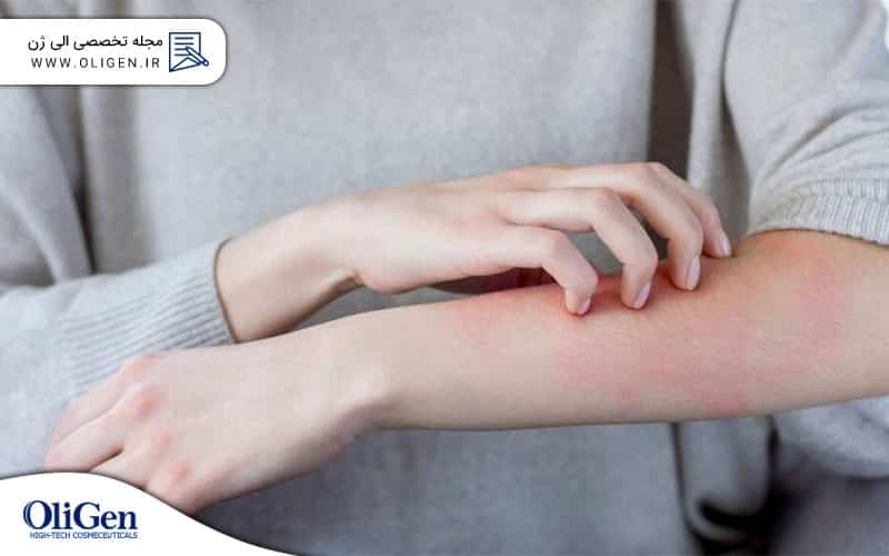برخی از رایج‌ ترین اختلالات پوستی