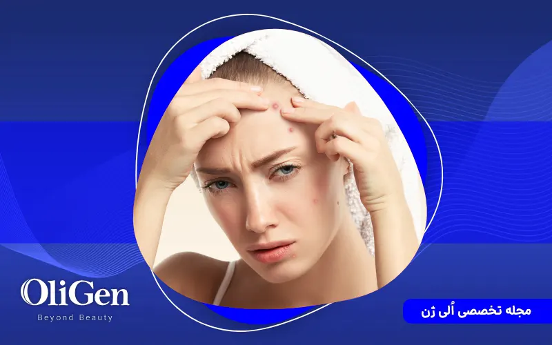 10 روش خانگی برای درمان جوش صورت