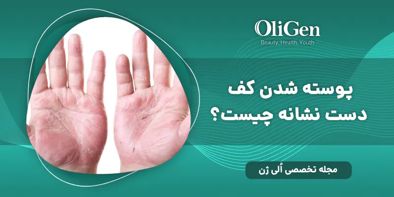 پوسته شدن دست، علت و راه های درمان